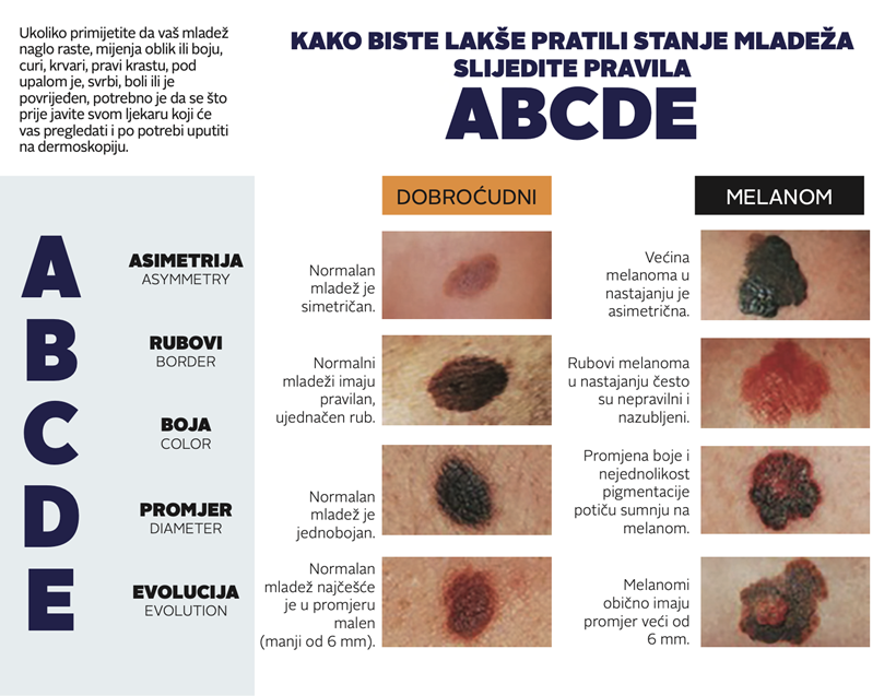 ABCDE_promjena_kože.png